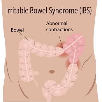 navigating the complex world of irritable bowel syndrome ibs